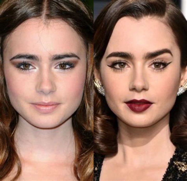 Actress Lily Collins Botox And Lip Filler With Her Before Ad After Photos